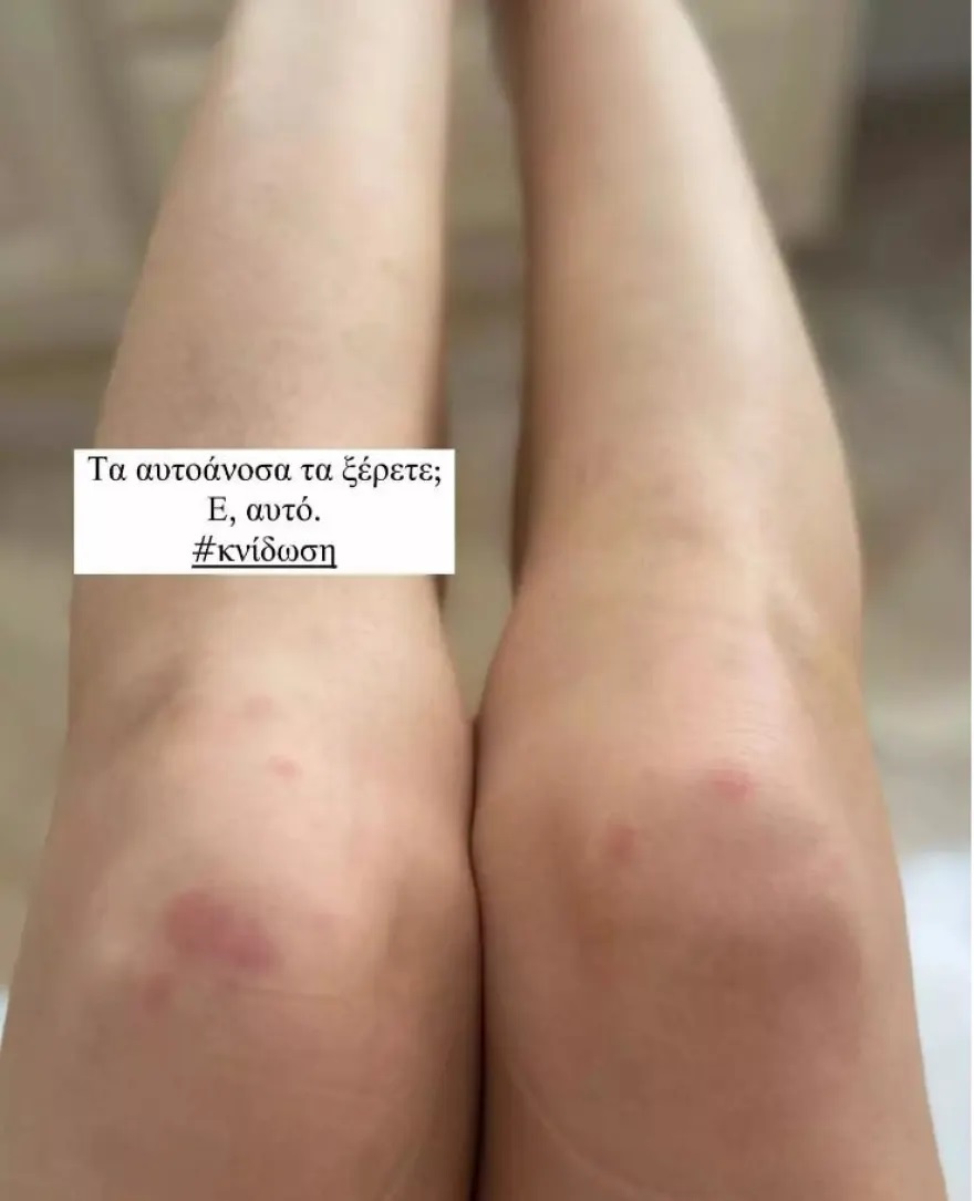 αυτοάνοσο κνίδωση γιάννα τερζή