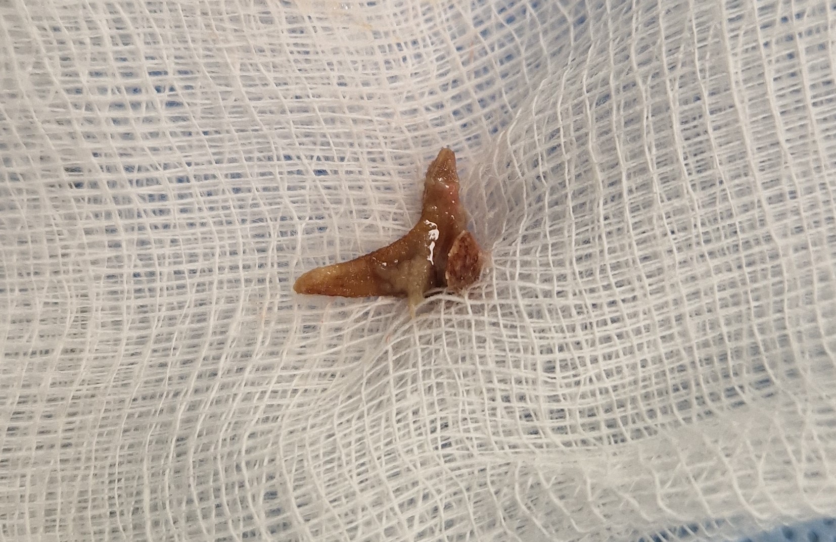 Κόκαλο Κουνέλι Πνευμονολόγος Βρογχοσκόπηση Χανιά