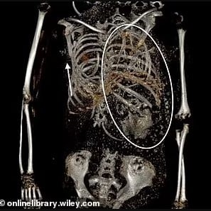 Το δεύτερο έμβρυο που ανακαλύφθηκε στον θώρακα της έφηβης δημιούργησε ερωτήματα Πηγή: Onlinelibreray.wiley.com