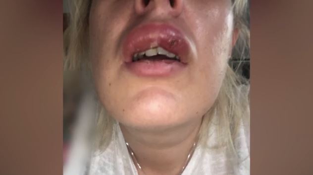 botox αισθητική επέμβαση Χείλη