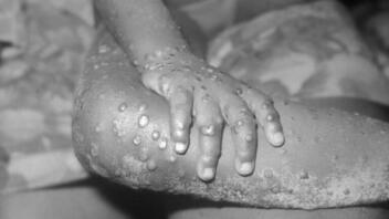 Όσλο: Οι υγειονομικές αρχές αναζητούν πιθανά κρούσματα της ευλογιάς των πιθήκων