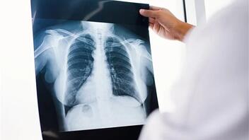 Καρκίνος Πνεύμονα: Υψηλά τα ποσοστά επιβίωσης και ίασης με την έγκαιρη διάγνωση