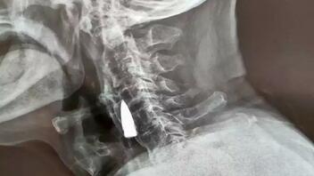 Απίστευτο: 95χρονος Κινέζος ανακάλυψε ότι ζούσε για 8 δεκαετίες με μια σφαίρα σφηνωμένη στον λαιμό του