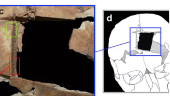 Άνθρωπος με τετράγωνη τρύπα στο κρανίο: Ένδειξη για χειρουργική εγκεφάλου πριν 3.500 χρόνια στο Ισραήλ