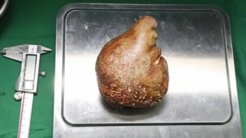 Αφαιρέθηκε η μεγαλύτερη μεγαλύτερη πέτρα νεφρού που έχει εντοπιστεί σε ασθενή