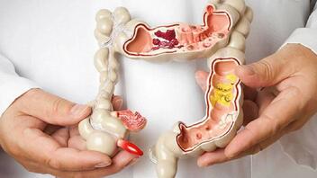 Οι παρεμβάσεις στη διάθεση μπορούν να μειώσουν τη φλεγμονή στη νόσο του Crohn και την ελκώδη κολίτιδα