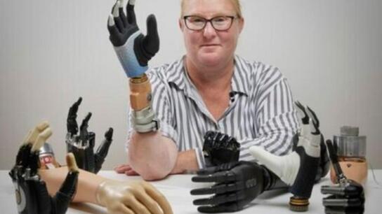 Η πρώτη «βιονική» γυναίκα στον κόσμο διαθέτει ρομποτικό χέρι που «ενσωματώνεται» στον σκελετό