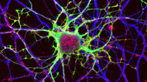 Πολλαπλή σκλήρυνση: Άκρως ενθαρρυντικά αποτελέσματα από πειραματική θεραπεία