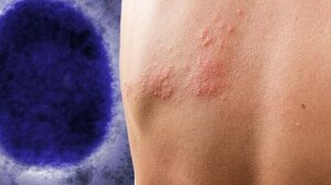 «Ευλογιά των πιθήκων»: Σε εγρήγορση ο ΕΟΔΥ, έστειλε εγκύκλιο στα νοσοκομεία