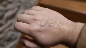 ΕΟΔΥ για την ευλογιά των πιθήκων: 20 τα κρούσματα στη χώρα