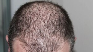 Τριχόπτωση: 6 τροφές που την καταπολεμούν