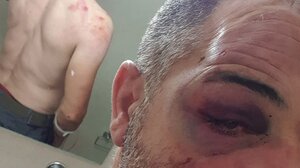 Έπεσε θύμα άγριου ξυλοδαρμού από πατέρα και γιο!