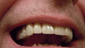 Από ποιες θανατηφόρες επιπλοκές προστατεύει το οδοντικό νήμα