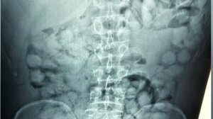 Ελ. Βενιζέλος: Αλλοδαπός είχε καταπιεί 100 «αυγά» που περιείχαν κοκαΐνη