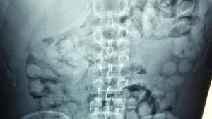 Συνελήφθη άνδρας στο Ελ. Βενιζέλος που είχε καταπιεί 100 συσκευασίες κοκαΐνης