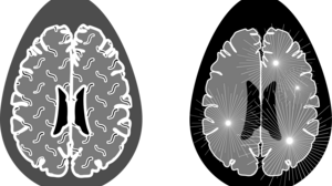 Σκλήρυνση κατά πλάκας: Μπορεί να ξεκινά πάνω από 10 χρόνια πριν τα συμπτώματα