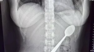 Απίστευτο ατύχημα στο Βέλγιο: 28χρονη κατάπιε κουτάλι 17 εκατοστών όταν πήδηξε πάνω της ο σκύλος της