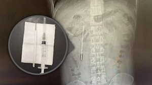 Κατάπιε θερμόμετρο όταν ήταν 12 ετών και το βρήκαν ... 20 χρόνια μετά