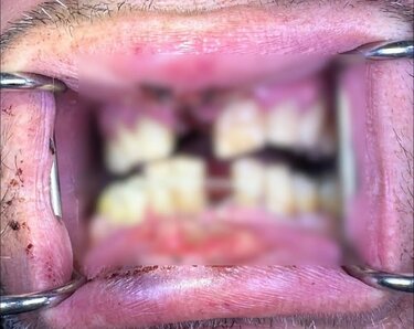 Ηλεκτρονικό τσιγάρο, Έκρηξη