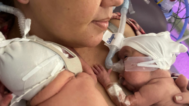 Τα πιο πρόωρα δίδυμα στο Ηνωμένο Βασίλειο γεννήθηκαν στις 22 εβδομάδες