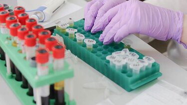 Ευλογιά των πιθήκων: Λήξη συναγερμού για το ύποπτο κρούσμα στην Ελλάδα