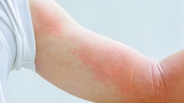 Δερματίτιδα – έκζεμα: Ανοίγουν νέες θεραπείες 