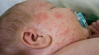 Οστρακιά: Συναγερμός στην Ευρώπη από την αύξηση κρουσμάτων