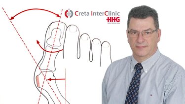 Νέα μέθοδος για το κότσι - Και άλλες παθήσεις του άκρου ποδός (αναίμακτα - χωρίς αναισθησία)