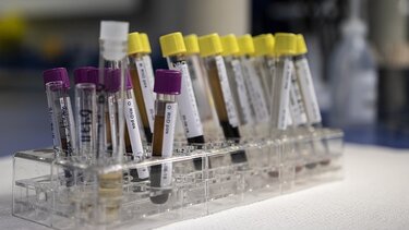 Χαμηλή κρεατινίνη: Συμπτώματα και αίτια