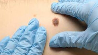 Καρκίνος του δέρματος: Πώς διαφέρει η εμφάνιση του σε άνδρες και γυναίκες