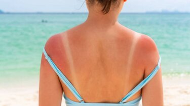 Κάηκες στον ήλιο; Τί πρέπει να κάνεις!