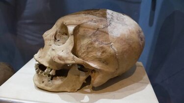 Στην Αρχαία Αίγυπτο η πρώτη επέμβαση αφαίρεσης καρκινικών όγκων στον εγκέφαλο ανθρώπων