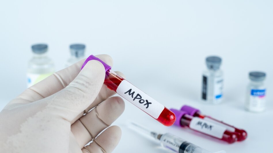 Νόσος mpox: Ποιοι κινδυνεύουν περισσότερο από το νέο, επιθετικό στέλεχος