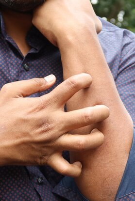 Δέρμα: Είναι το στρες «ένοχο» για το έκζεμα; 